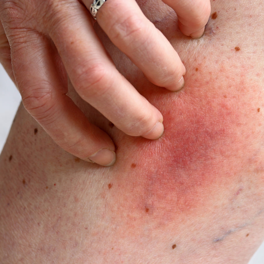 Itch-eze Pain Relief Soothing Lotion for stings and bites Fast-Acting Relief When You Need It Most Volume 100mls