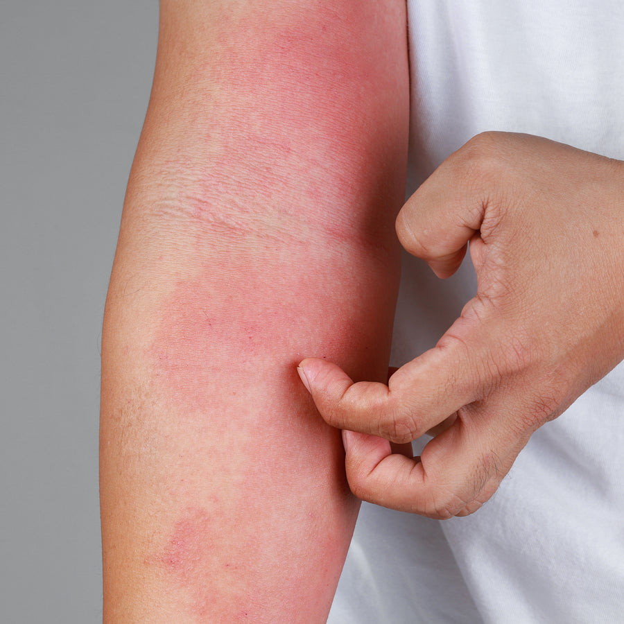 Itch-eze Pain Relief Soothing Lotion for stings and bites Fast-Acting Relief When You Need It Most Volume 100mls